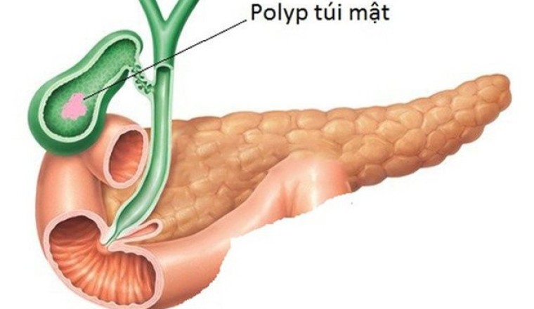 Polyp túi mật có nguy cơ chuyển thành ung thư, Xem chi tiết chuyên gia chia sẻ những dấu hiệu nhận biết