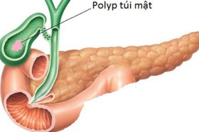 Polyp túi mật có nguy cơ chuyển thành ung thư, Xem chi tiết chuyên gia chia sẻ những dấu hiệu nhận biết