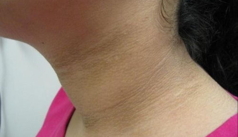 5 Vị trí trên cơ thể tự nhiên xuất hiện vết đen báo hiệu bệnh ung thư