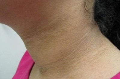 5 Vị trí trên cơ thể tự nhiên xuất hiện vết đen báo hiệu bệnh ung thư