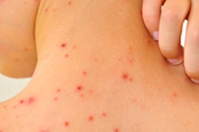 Bài thuốc đông y điều trị sốt xuất huyết