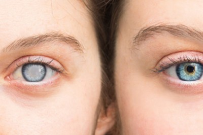 Thuốc điều trị đục thủy tinh thể- Niềm hy vọng về phương pháp điều trị mới thay phẫu thuật