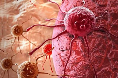 Phát hiện đột phá về thời điểm lây lan nhanh nhất của tế bào ung thư