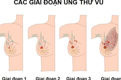 Phát hiện mới trong điều trị ung thư vú