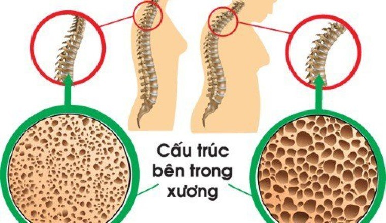 5 cây thuốc nam, cây thảo dược hỗ trợ ngăn ngừa loãng xương