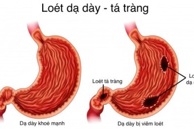 Cây thuốc nam, cây thảo mộc, thảo dược giúp giảm viêm loét dạ dày