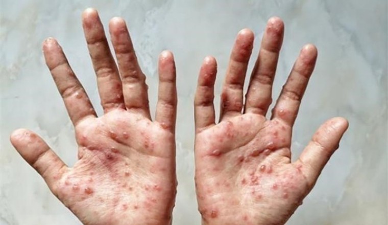 Phân biệt đậu mùa khỉ với thủy đậu, tay chân miệng