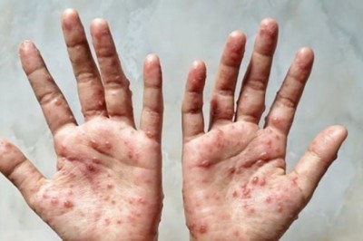 Phân biệt đậu mùa khỉ với thủy đậu, tay chân miệng