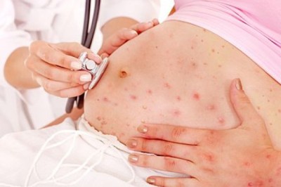 Thai phụ cẩn trọng không để mắc đậu mùa khỉ