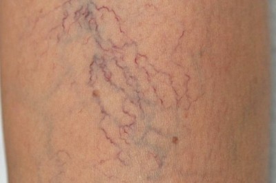 Tác dụng của hạt dẻ ngựa với chứng giãn tĩnh mạch chân