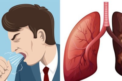 Ung thư phổi liệu có di truyền?