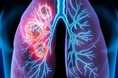 2 người trong cùng một nhà mắc ung thư phổi: Bác sĩ chỉ ra nguyên nhân