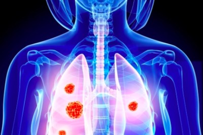 13 triệu chứng 'báo động đỏ' bệnh ung thư, bạn nhất định phải lưu ý