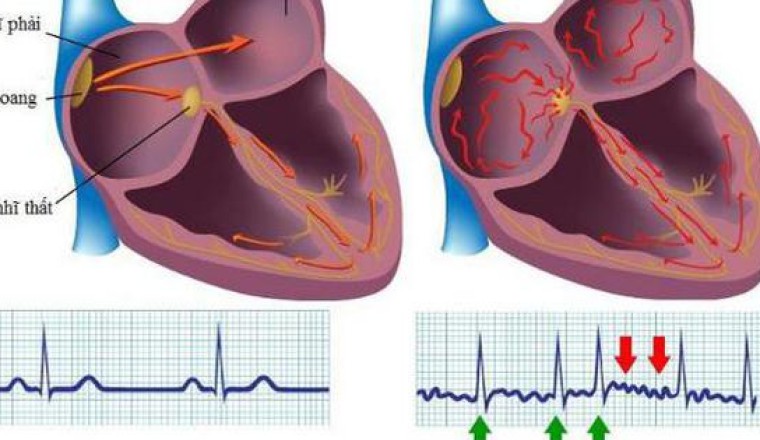 Dấu hiệu, Triệu chứng cảnh báo 6 bệnh tim mạch thường gặp nhất