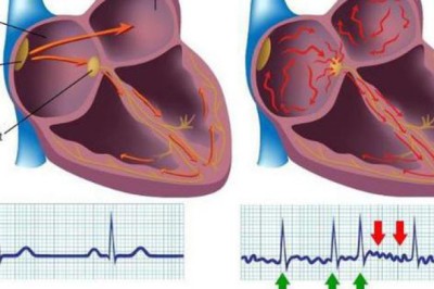 Dấu hiệu, Triệu chứng cảnh báo 6 bệnh tim mạch thường gặp nhất