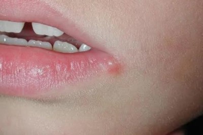 Những cách chữa mụn rộp do herpes tại nhà