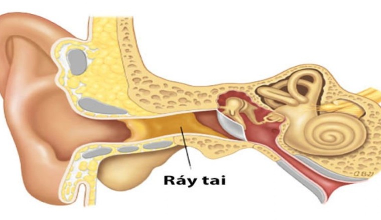Tác dụng ít người biết của ráy tai