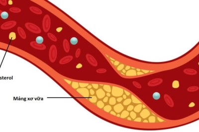 10 bài thuốc nam cực hiệu quả trị tăng mỡ máu (cholesterol)