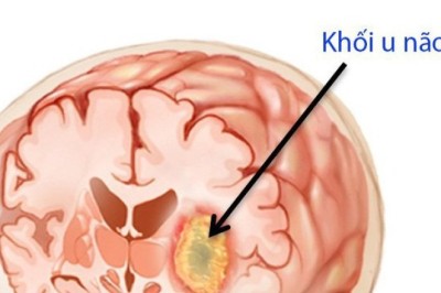 Ung thư não là gì?