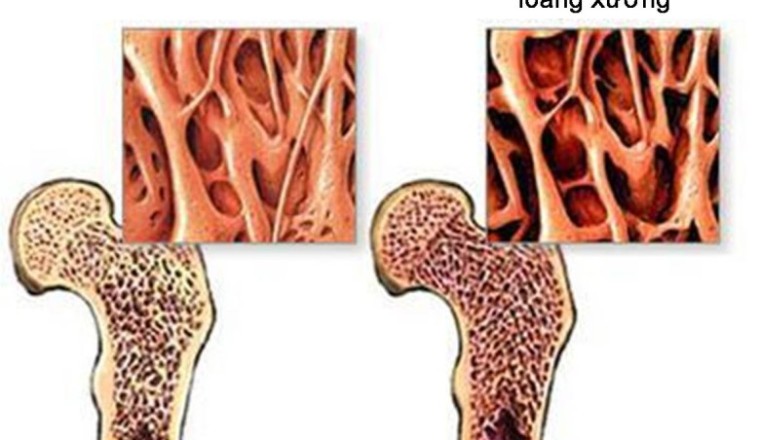 Bệnh loãng xương đông y dùng nhưng bài thuốc dưới đây