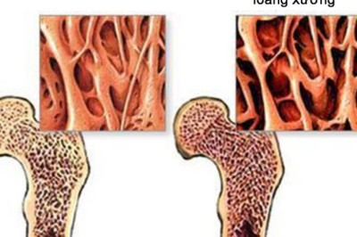 Bệnh loãng xương đông y dùng nhưng bài thuốc dưới đây