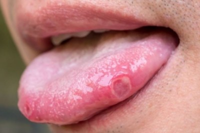 Ung thư lưỡi - triệu chứng dễ nhầm với viêm, nhiệt miệng