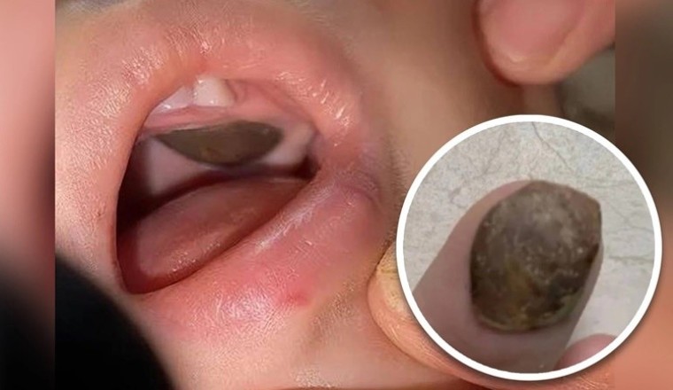 Bé trai mắc vỏ hạt sen trong miệng bị chẩn đoán nhầm có khối u