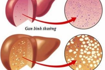 4 bài thuốc nam trị bệnh gan nhiễm mỡ hiệu quả