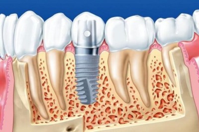 Lịch sử ra đời và phát triển của những chiếc răng giả