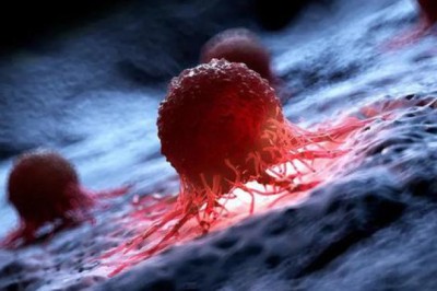 14 loại ung thư tăng cao toàn cầu: Do trẻ em học, chơi khuya, ăn vội?