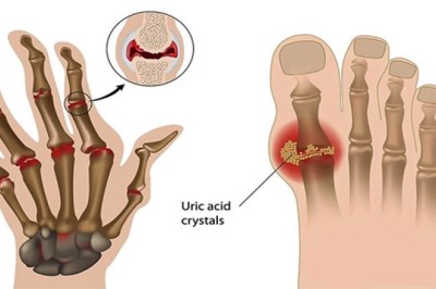 Diệp hạ châu và Râu mèo làm tăng hiệu quả hạ acid uric máu tốt nhất