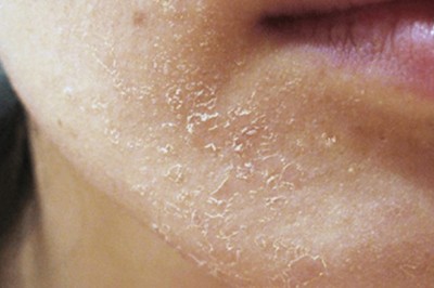 5 bài thuốc nam phòng ngừa da khô ráp, bong tróc