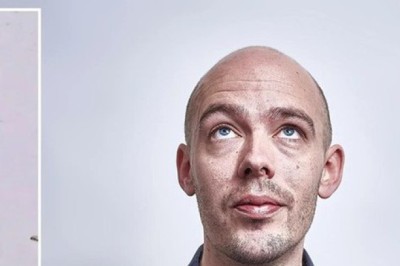 Tìm ra cách mới chữa hói đầu