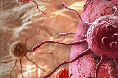 Tập Aerobic có thể giúp giảm 72% nguy cơ ung thư di căn