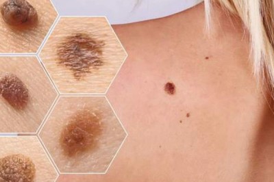 Cảnh báo các dấu hiệu sớm bệnh ung thư hắc tố tin mới nhất