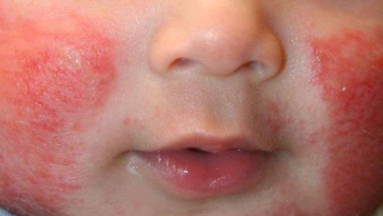 Kem dưỡng ẩm da có giúp ngăn ngừa bệnh chàm ở trẻ sơ sinh?