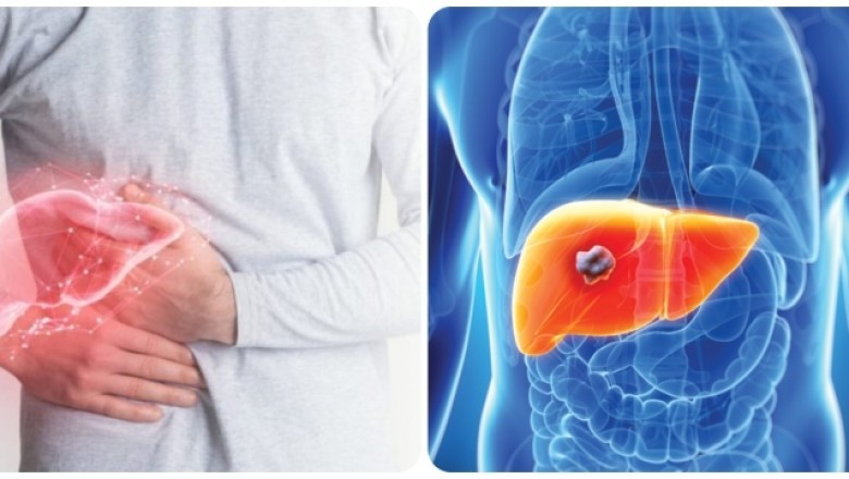 9 dấu hiệu ung thư gan giai đoạn đầu dễ nhầm với bệnh lý khác