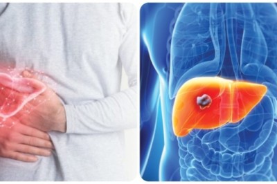 9 dấu hiệu ung thư gan giai đoạn đầu dễ nhầm với bệnh lý khác