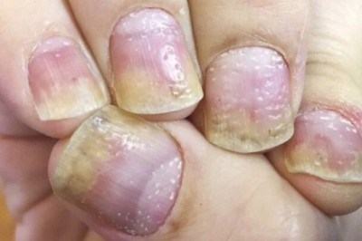 Móng tay bị rỗ là bệnh gì?