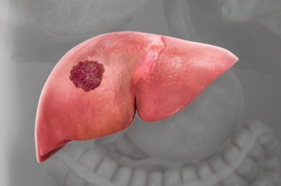 9 dấu hiệu nhận biết ung thư gan sớm nhất và chính xác nhất