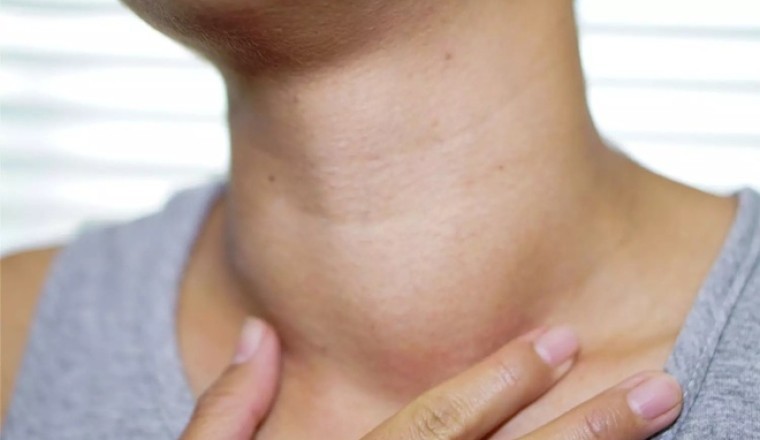 Số người mắc ung thư tuyến giáp ngày càng tăng ở cả Nam và Nữ