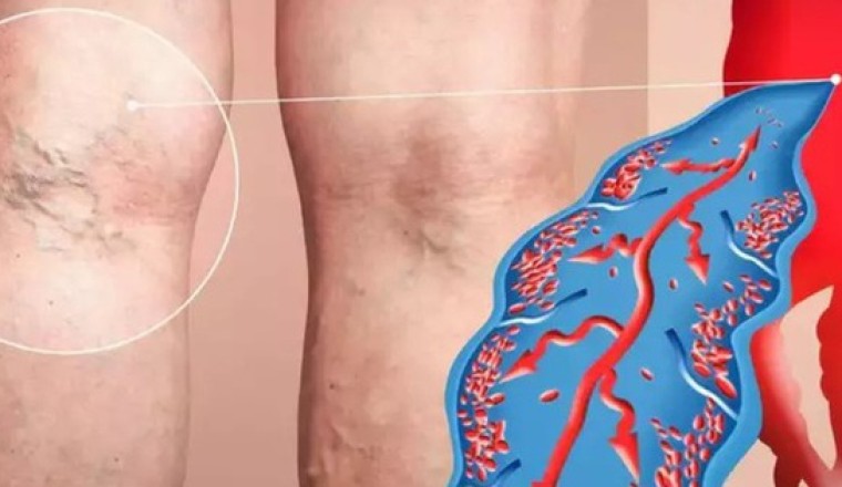 4 dấu hiệu cảnh báo cục máu đông trong cơ thể