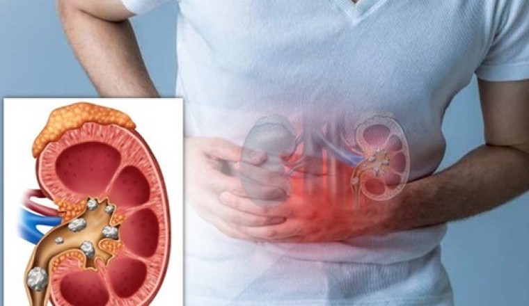 3 cây thảo dược hỗ trợ điều trị sỏi đường tiết niệu