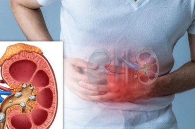 3 cây thảo dược hỗ trợ điều trị sỏi đường tiết niệu