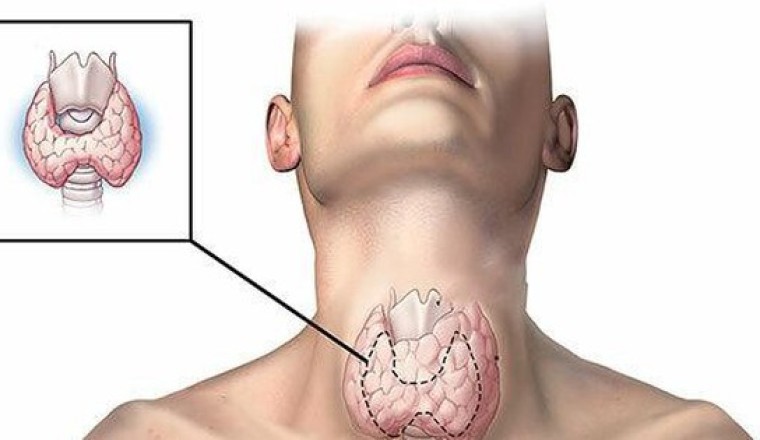 Dấu hiệu bất thường cảnh báo nguy cơ bị ung thư tuyến giáp, tuyệt đối không được bỏ qua