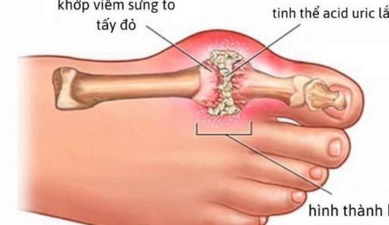 Phòng bệnh gout tái phát bằng món ăn bài thuốc đơn giản tại nhà