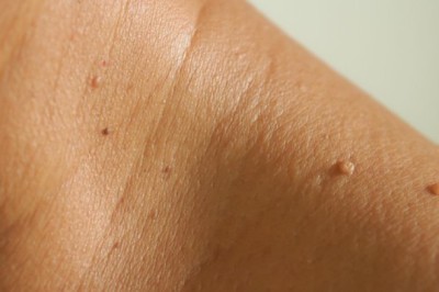 Dấu hiệu 'nhỏ' trên da có thể cảnh báo tiểu đường, xuất hiện ở 4 vị trí này càng cần chú ý