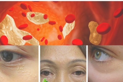 Dấu hiệu cảnh báo cholesterol cao có thể xuất hiện ở mắt