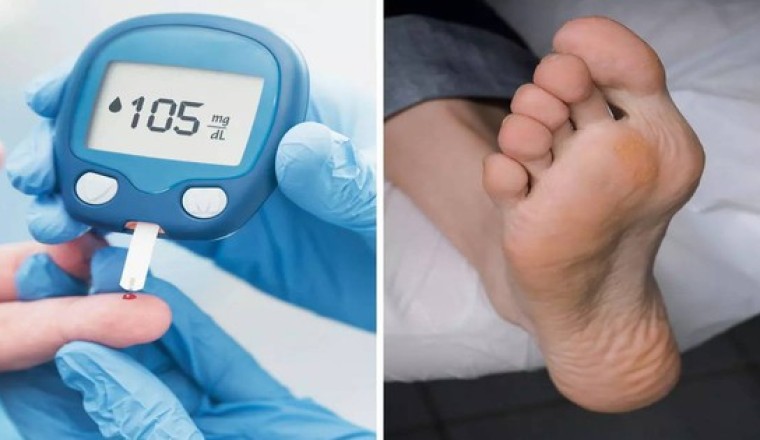 3 biểu hiện khác thường ở bàn chân là dấu hiệu của bệnh Tiểu Đường