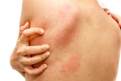 Ngứa da dầu, người đàn ông qua đời sau 3 tháng: 4 cơn ngứa cảnh báo bệnh nặng hoặc ung thư